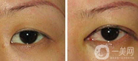 開(kāi)眼角手術(shù)