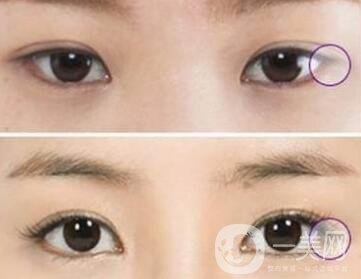 開(kāi)眼角手術(shù)