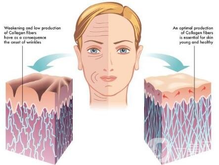 冰電波拉皮除皺*果如何？有哪些優(yōu)點(diǎn)？