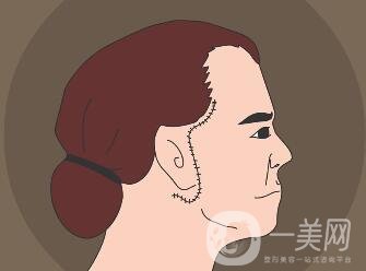 冰電波拉皮除皺*果如何？有哪些優(yōu)點(diǎn)？