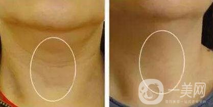 冰電波拉皮除皺*果如何？有哪些優(yōu)點(diǎn)？