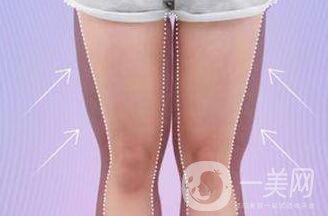 大腿環(huán)形吸脂多久恢復(fù)？會(huì)有疤嗎？