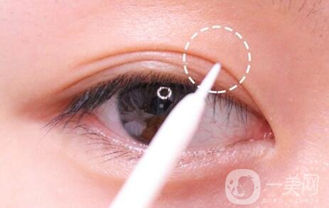 做雙眼皮手術(shù)過程