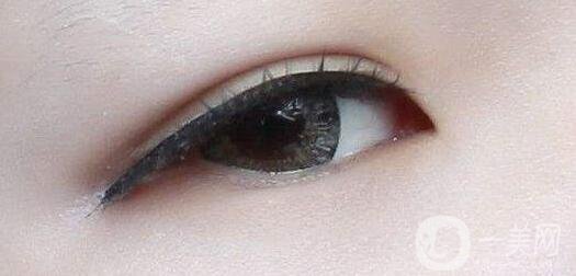 做雙眼皮手術(shù)過程