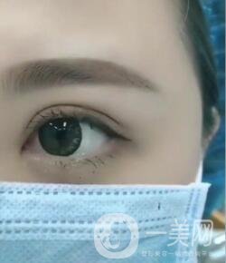做雙眼皮手術(shù)過程