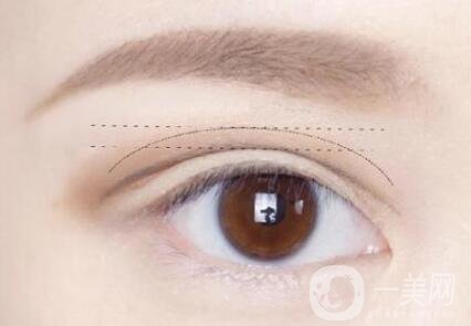 做雙眼皮手術(shù)過程