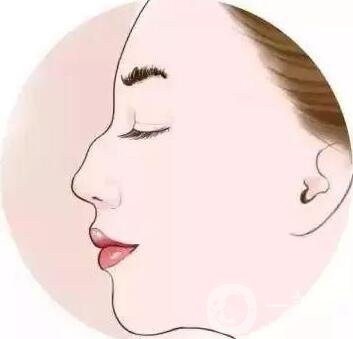 如何讓鼻梁變高？可以注射玻尿酸嗎？