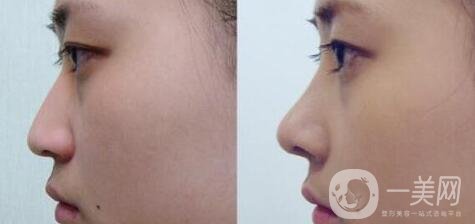 隆鼻手術(shù)