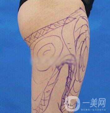 大腿部吸脂塑形術(shù)后護理的那些事兒