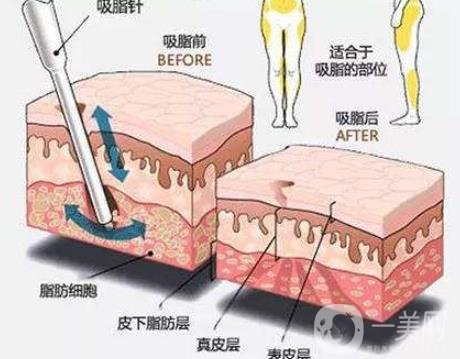 全身抽脂減肥價(jià)格大概要多少錢？