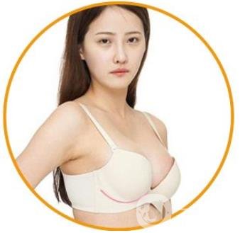 娜綺麗隆胸多久變軟？怎么加速變軟？