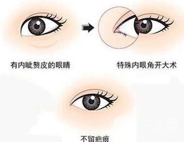 開眼角手術(shù)過程中疼嗎?要多久?