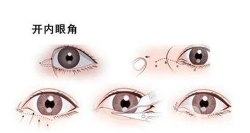 開眼角手術(shù)過程中疼嗎?要多久?