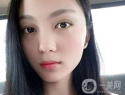 吸雕雙眼皮手術是什么？是埋線嗎？