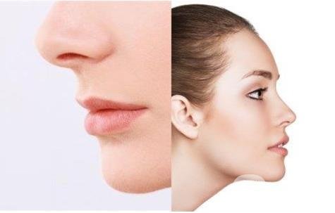 怎樣讓鼻子變高？隆鼻可以讓鼻子變高嗎？