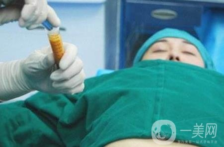 全身抽脂手術(shù)要多久？要花多少錢？