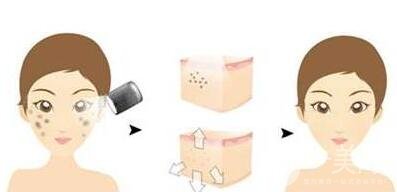 光子嫩膚的原理是什么？*果怎樣？