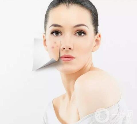 怎么樣去除痘印?哪種方法*靠譜?