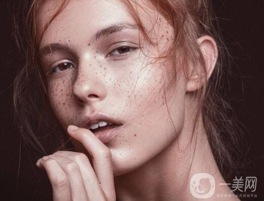 激光去除黃褐斑的*果怎么樣?