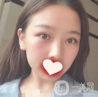 西南醫(yī)院整形美容外科雙眼皮