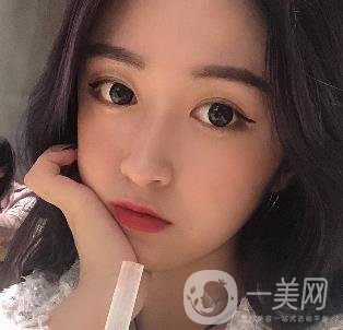 西安葉子整形美容醫(yī)院雙眼皮