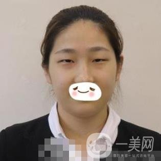 濟南旭美整形醫(yī)院靠譜嗎?附雙眼皮案例和全新價格表