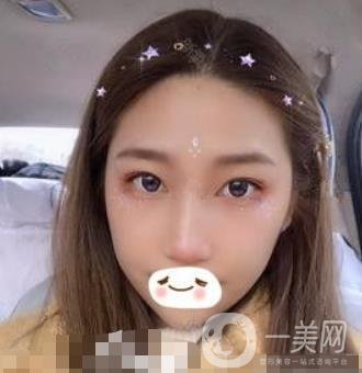 濟南旭美整形醫(yī)院靠譜嗎?附雙眼皮案例和全新價格表