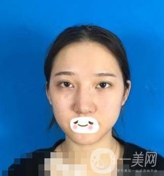 廣州禾麗醫(yī)院做雙眼皮怎么樣?看*果圖和價(jià)格表