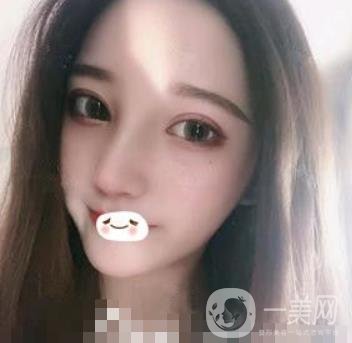 廣州禾麗醫(yī)院做雙眼皮怎么樣?看*果圖和價(jià)格表