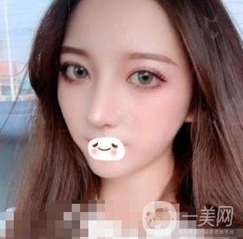 廣州禾麗醫(yī)院做雙眼皮怎么樣?看*果圖和價(jià)格表