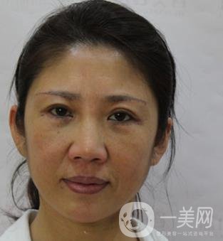 安徽醫(yī)科大學(xué)第(一)附屬醫(yī)院整形外科價格表，附去眼袋案例