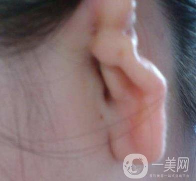 2020年石家莊第(一)醫(yī)院整形美容科價(jià)格表和耳朵畸形修復(fù)案例一覽