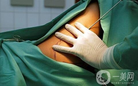 關(guān)于吸脂手術(shù)的流程與*性，你都知道嗎？