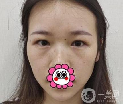 金華中心醫(yī)院整形美容科價(jià)格表+割雙眼皮案例一覽
