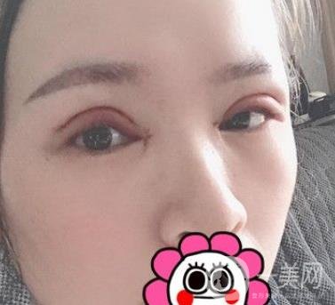 金華中心醫(yī)院整形美容科價(jià)格表+割雙眼皮案例一覽