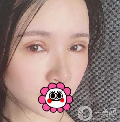 金華中心醫(yī)院整形美容科價(jià)格表+割雙眼皮案例一覽