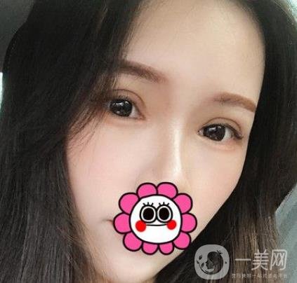 金華中心醫(yī)院整形美容科價(jià)格表+割雙眼皮案例一覽