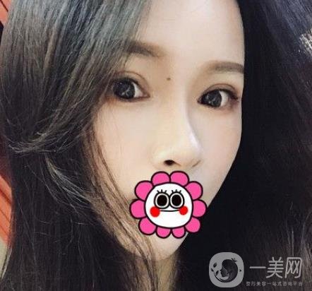 金華中心醫(yī)院整形美容科價(jià)格表+割雙眼皮案例一覽