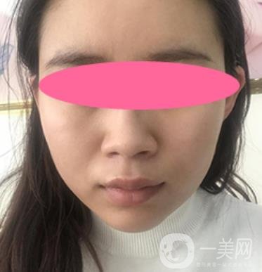 寧波第一醫(yī)院整形科價格表收費明細上線，看打玻尿酸真人案例