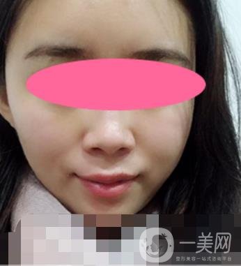 寧波第一醫(yī)院整形科價格表收費明細上線，看打玻尿酸真人案例