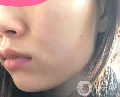 寧波第一醫(yī)院整形科價格表收費明細上線，看打玻尿酸真人案例