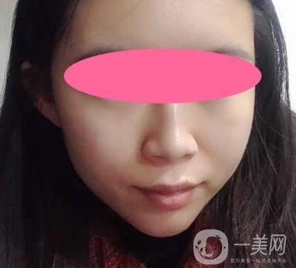 寧波第一醫(yī)院整形科價格表收費明細上線，看打玻尿酸真人案例