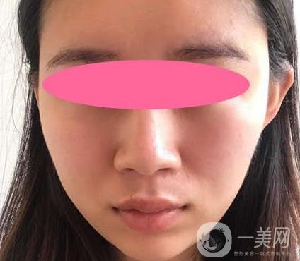 寧波第一醫(yī)院整形科價格表收費明細上線，看打玻尿酸真人案例