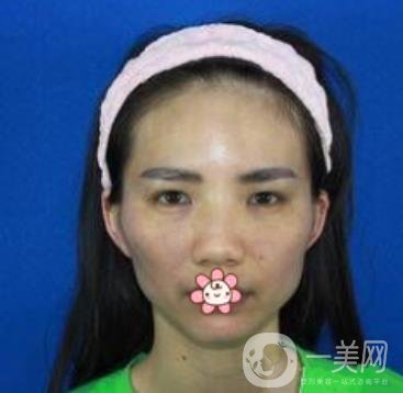 上海第九人民醫(yī)院整形外科價格表，附面部脂肪填充案例