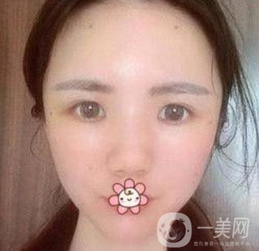 上海第九人民醫(yī)院整形外科價格表，附面部脂肪填充案例