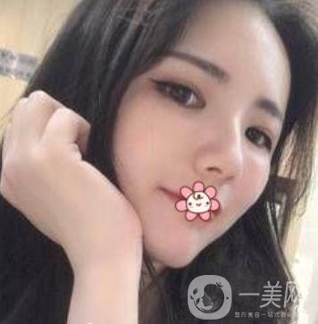 上海第九人民醫(yī)院整形外科價格表，附面部脂肪填充案例