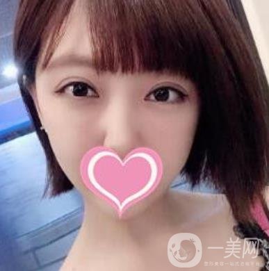 上海第一醫(yī)院整形外科價格表明細及割雙眼皮日記分享