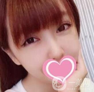 上海第一醫(yī)院整形外科價格表明細及割雙眼皮日記分享