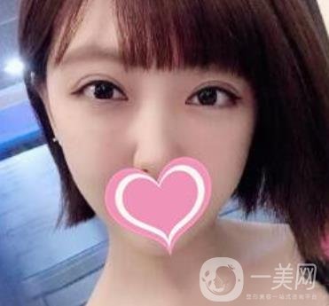 上海第一醫(yī)院整形外科價格表明細及割雙眼皮日記分享