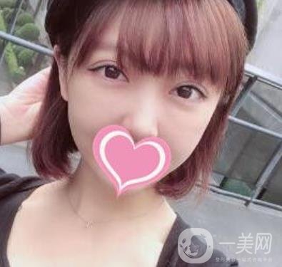 上海第一醫(yī)院整形外科價格表明細及割雙眼皮日記分享